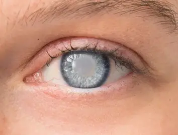 المياه البيضاء (الساد)