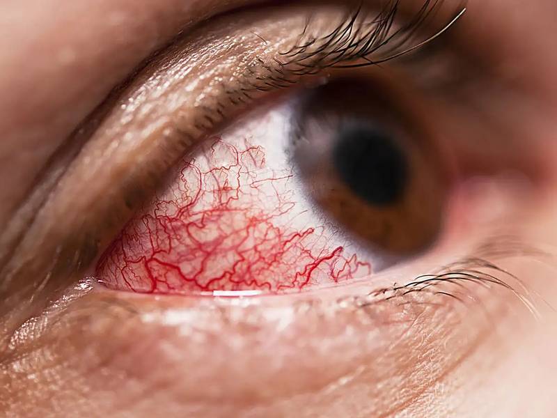 Diabetic Eye Diseases